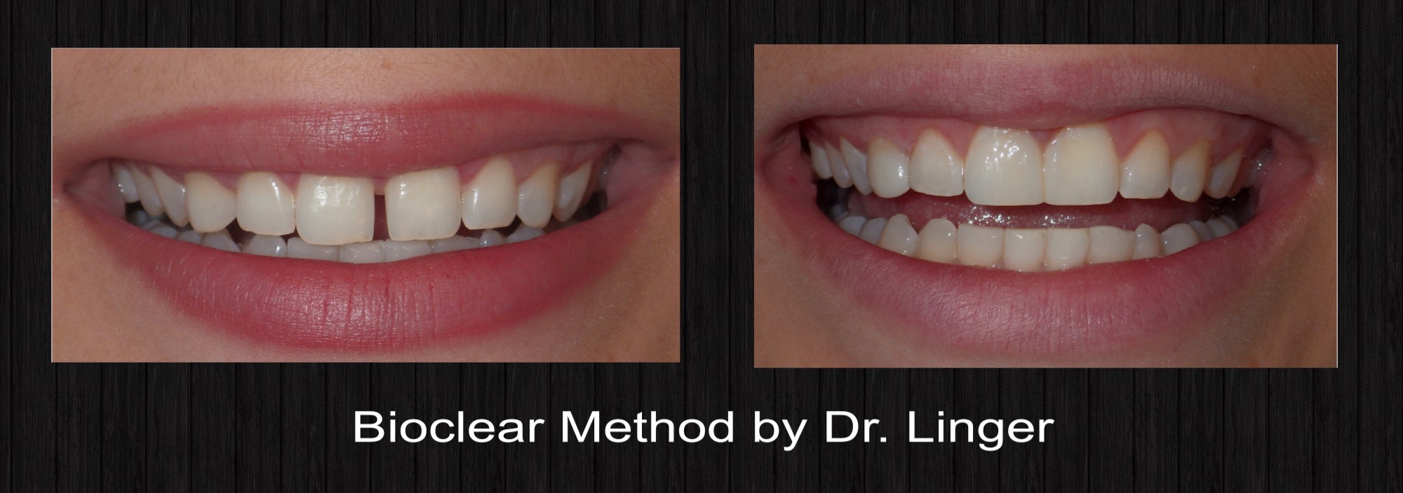 Bioclear Dental Bonding Charlotte NC William Linger, DDS, MAGD